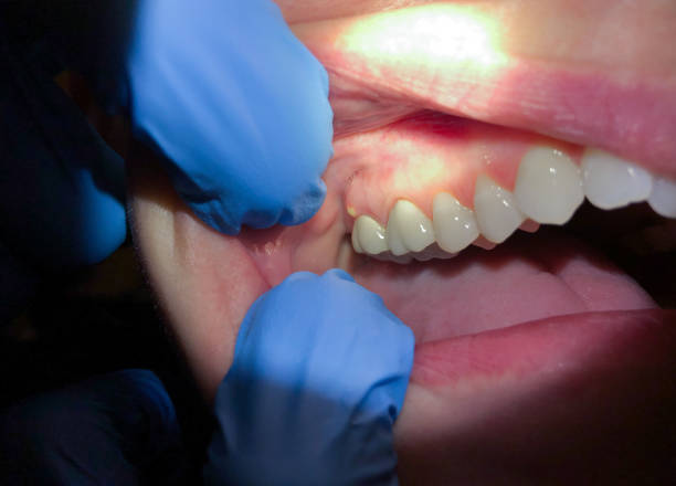 Best Dental Abscess Treatment in Weston, NJ